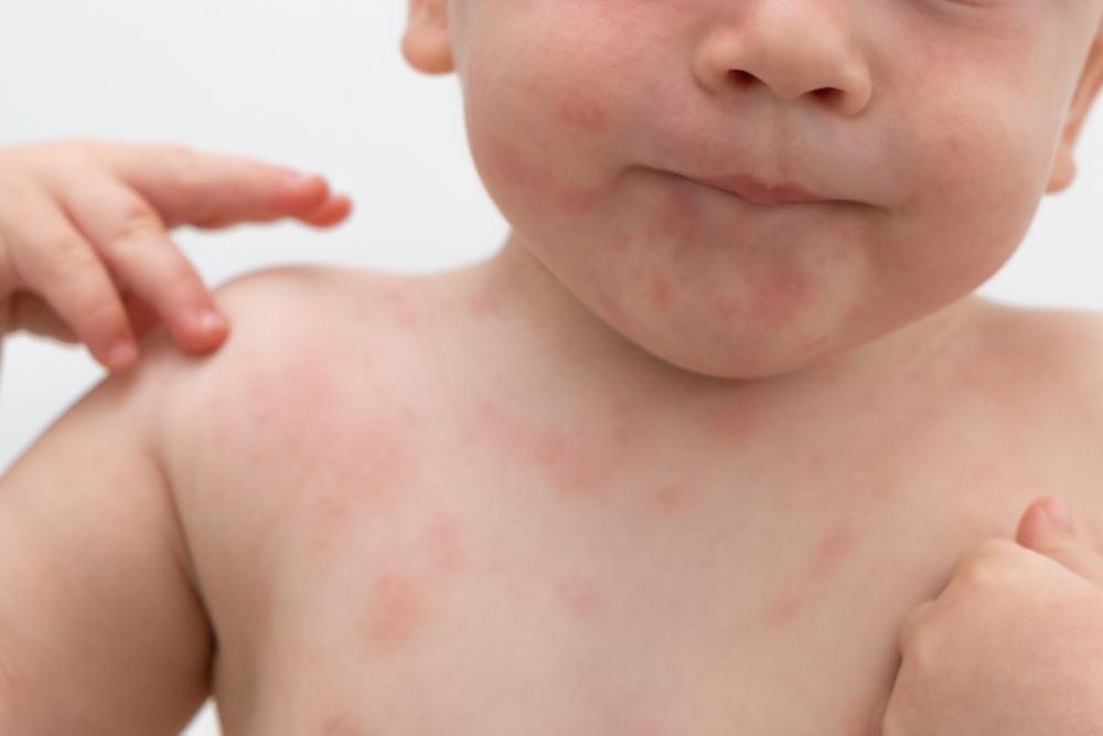 Alergias alimentarias: ¿Cómo saber si mi hijo es alérgico a un alimento?