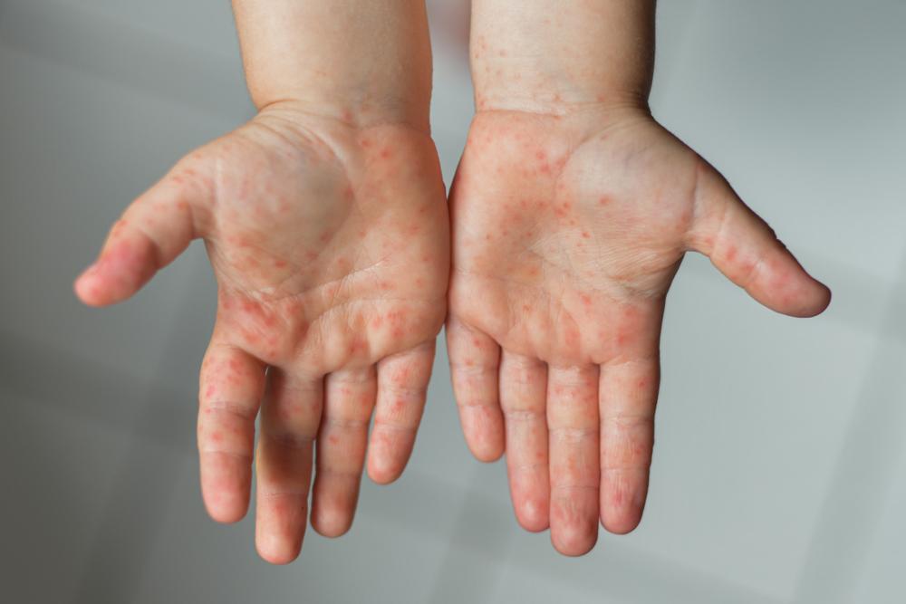 ¿Qué es la enfermedad de manos, pies y boca?