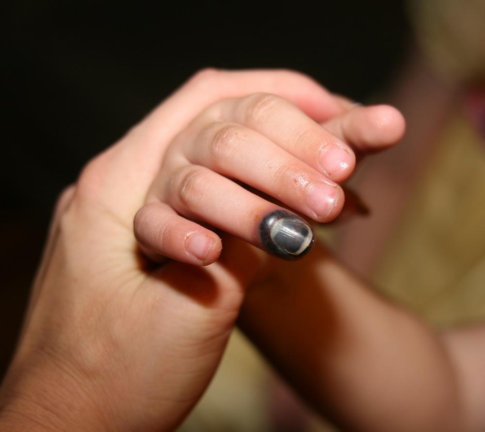 ¿Qué hago si mi hijo se chanca el dedo?