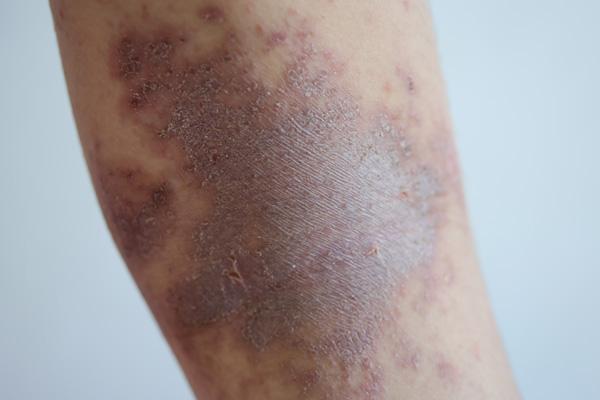 Todo lo que debes saber sobre la psoriasis en la infancia