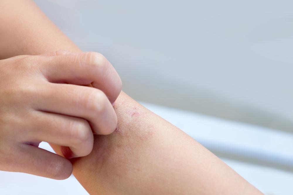 Cuidado con la sarna en niños: Te contamos todo lo que debes saber para prevenirla