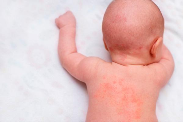 Yo Me Cuido | Bebés y niños: ¿Cómo saber si mi hijo es alérgico a un  alimento?